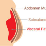 visceral fat or subcutaneous fat
